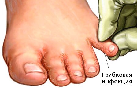 Симптомы грибка стоп и ног
