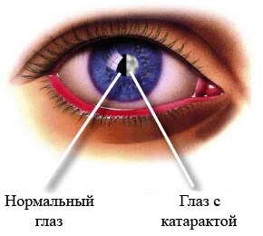 катаракта - помутнение хрусталика